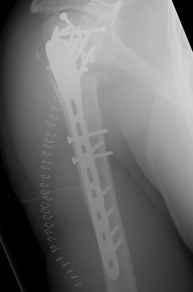 Proximal humerus ORIF 1